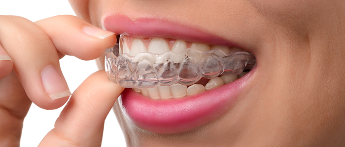A clear aligner on the teeth.