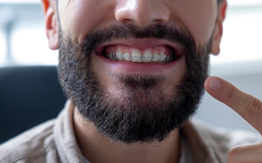 Clear Braces