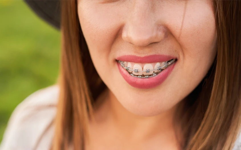 Damon Braces